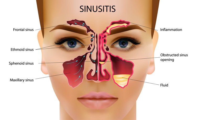 sinusitis or penus rog